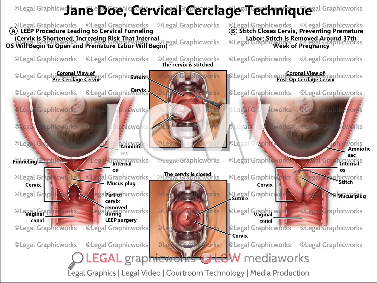 Cervical Cerclage Technique
