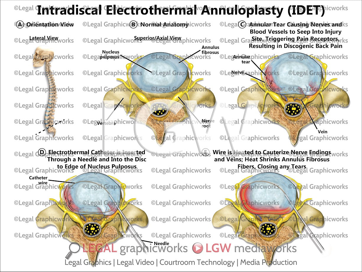 Intradiscal Electrothermal Annuloplasty (IDET)