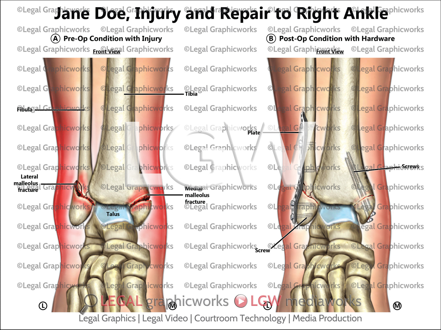 Injury and Repair to Right Ankle