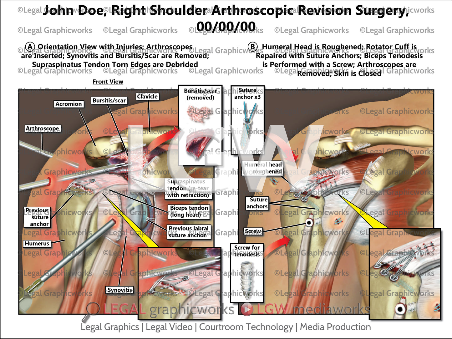 Right Shoulder Arthroscopic Revision Surgery