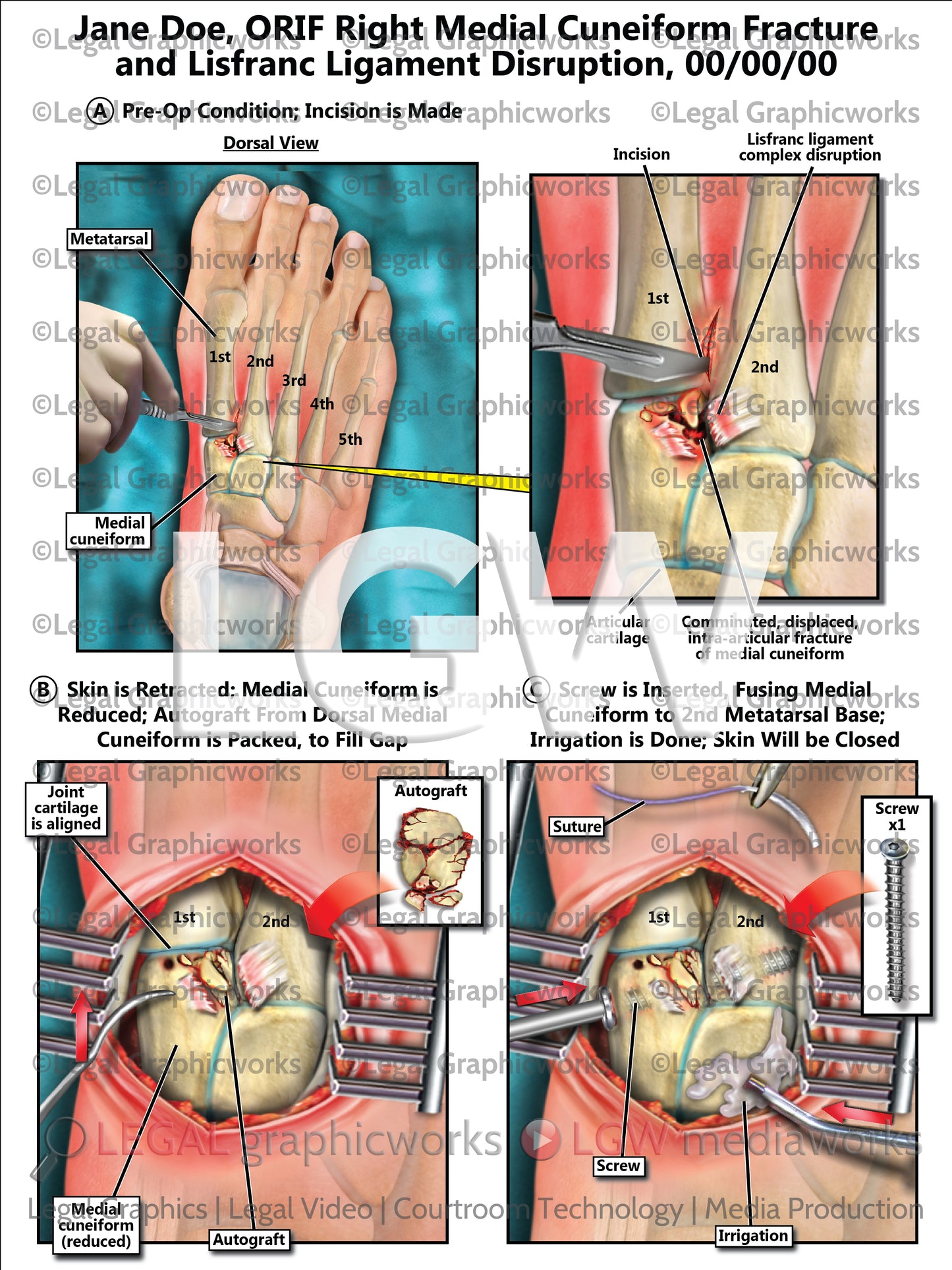 ORIF Right Medial Cuneiform Fracture and Lisfranc Ligament Disruption