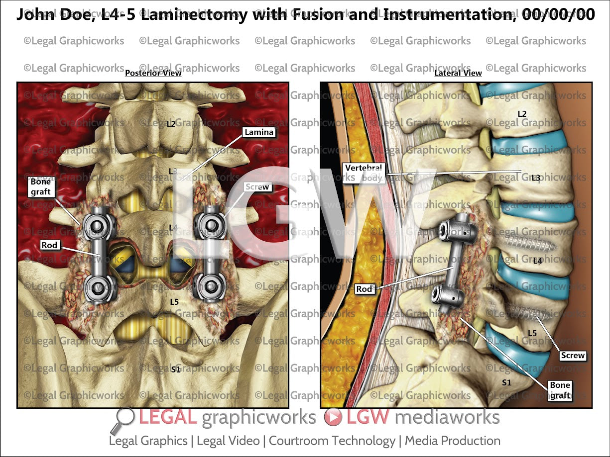 L4-5 Laminectomy with Fusion and Instrumentation
