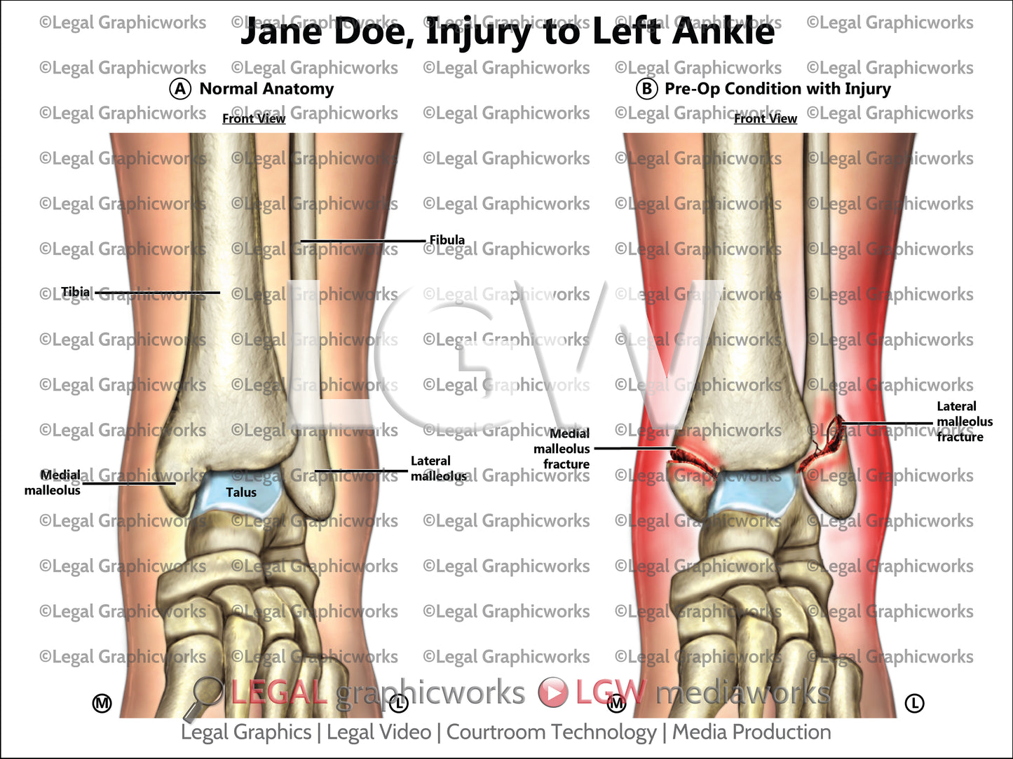Injury to Left Ankle