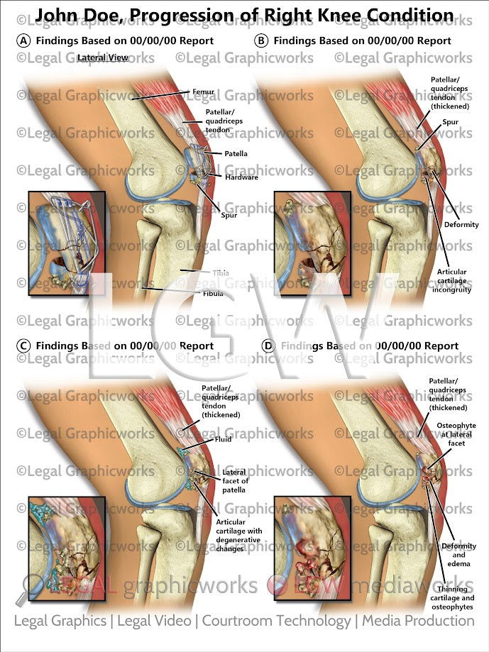 Progression of Right Knee Condition