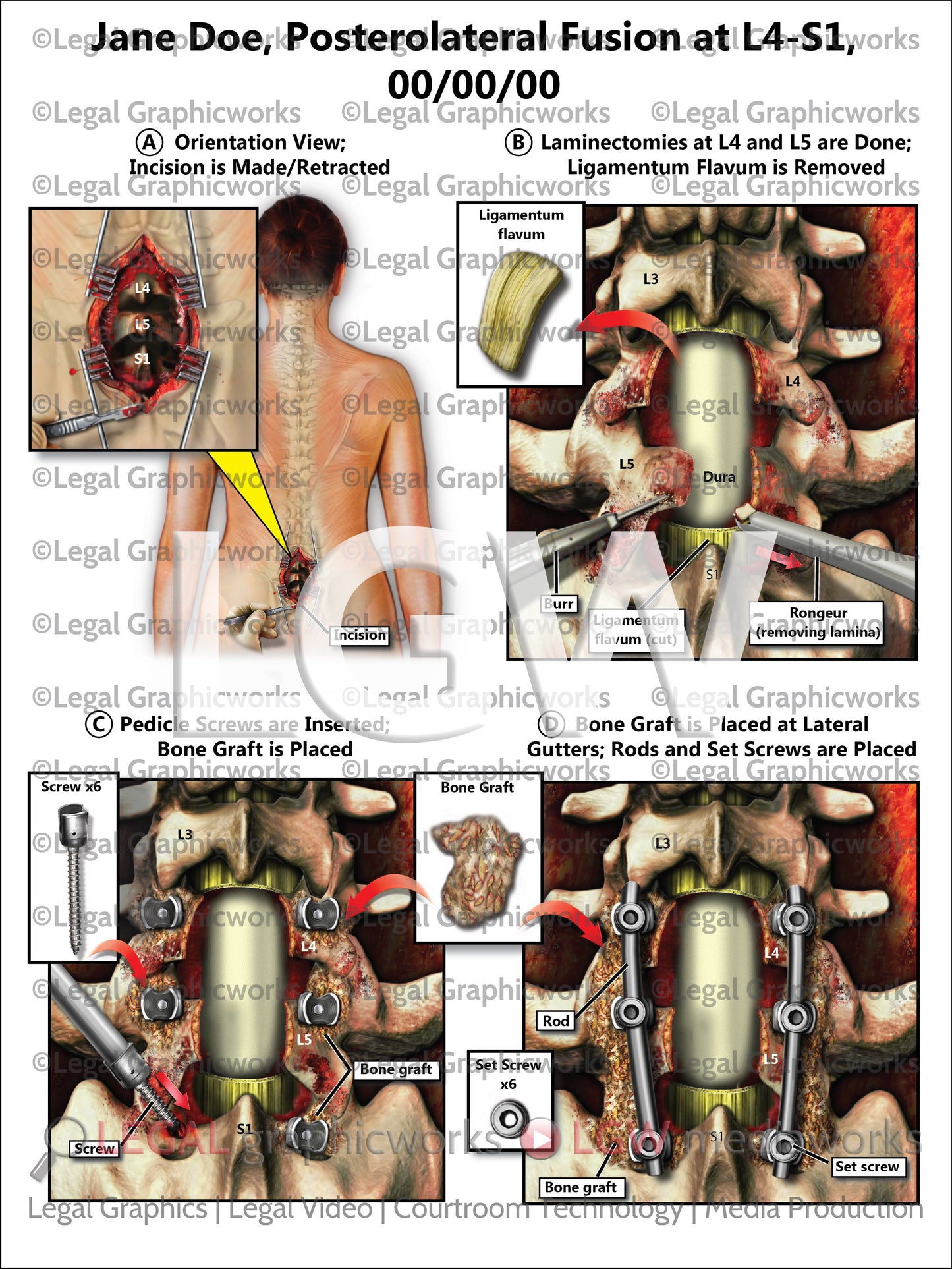Posterolateral Fusion at L4-S1