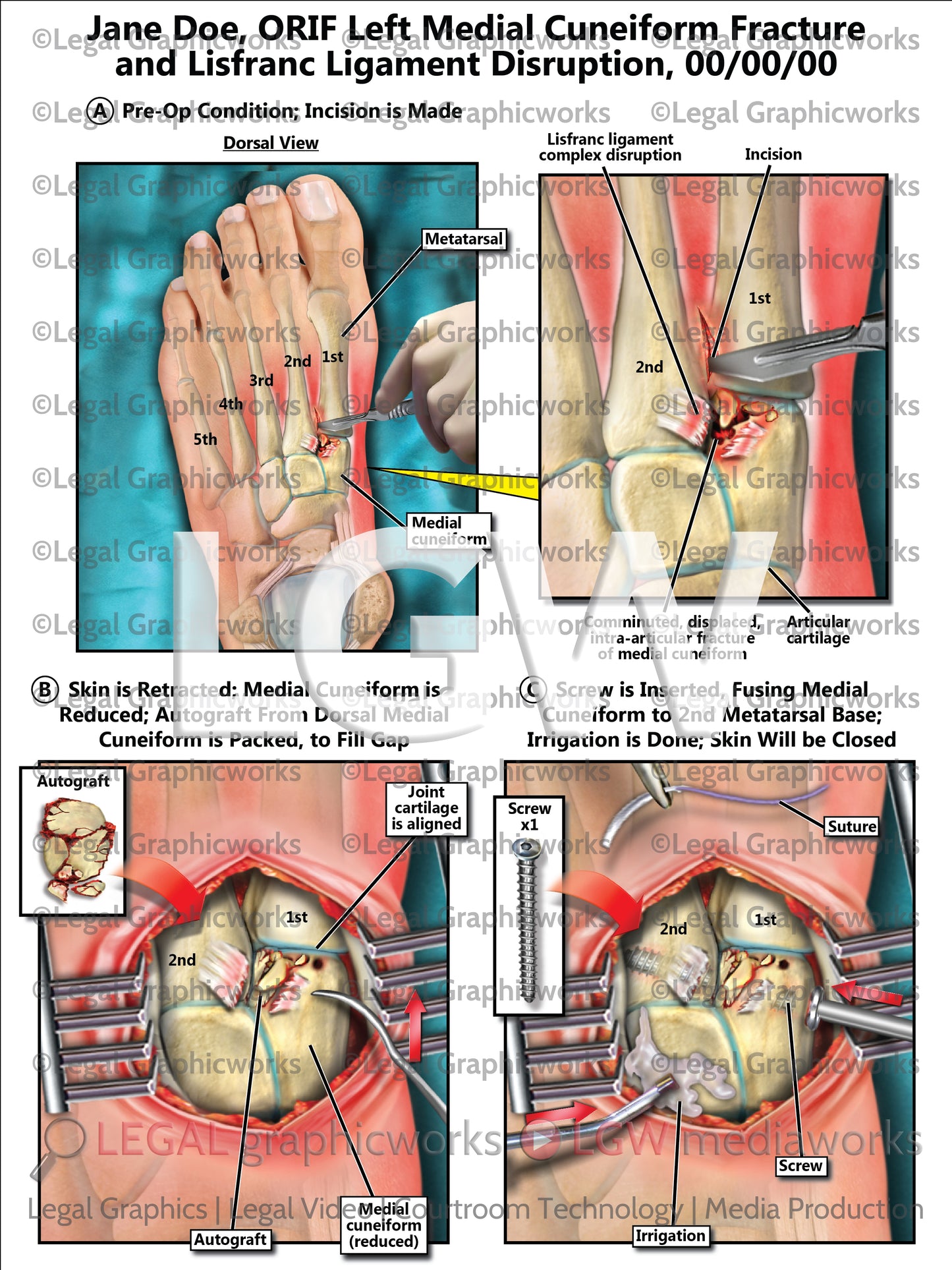 ORIF Left Medial Cuneiform Fracture and Lisfranc Ligament Disruption