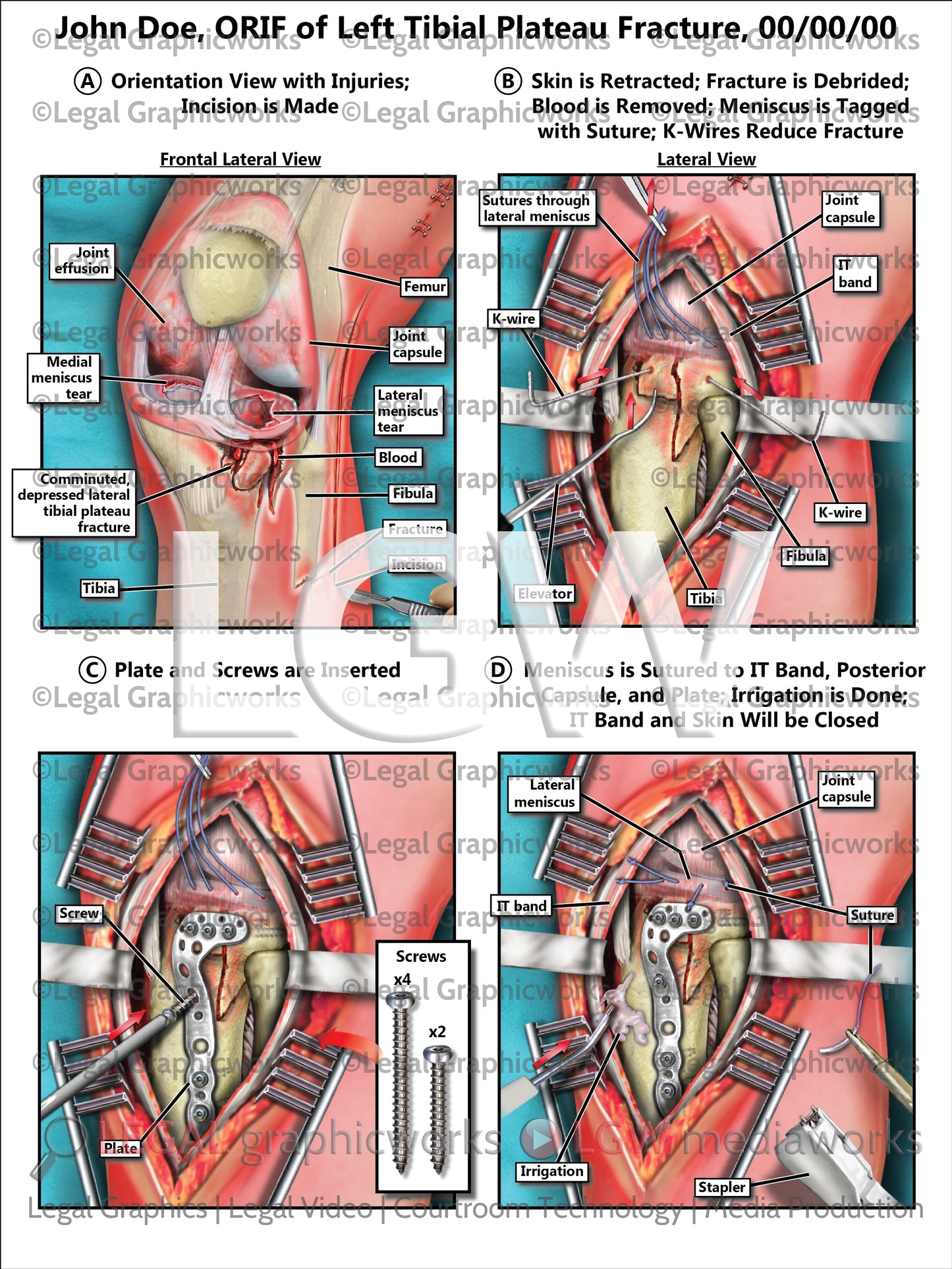 ORIF of Left Tibial Plateau Fracture