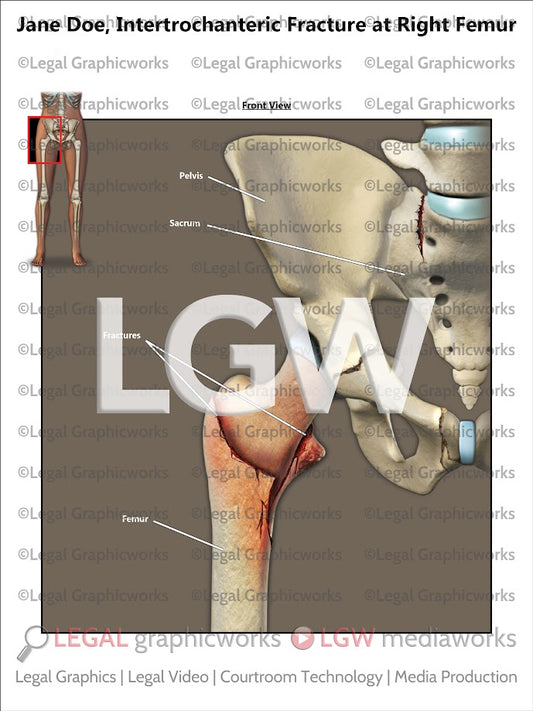 Intertrochanteric Fracture at Right Femur