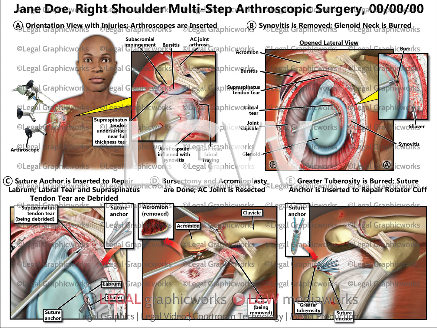Right Shoulder Multi-Step Arthroscopic Surgery