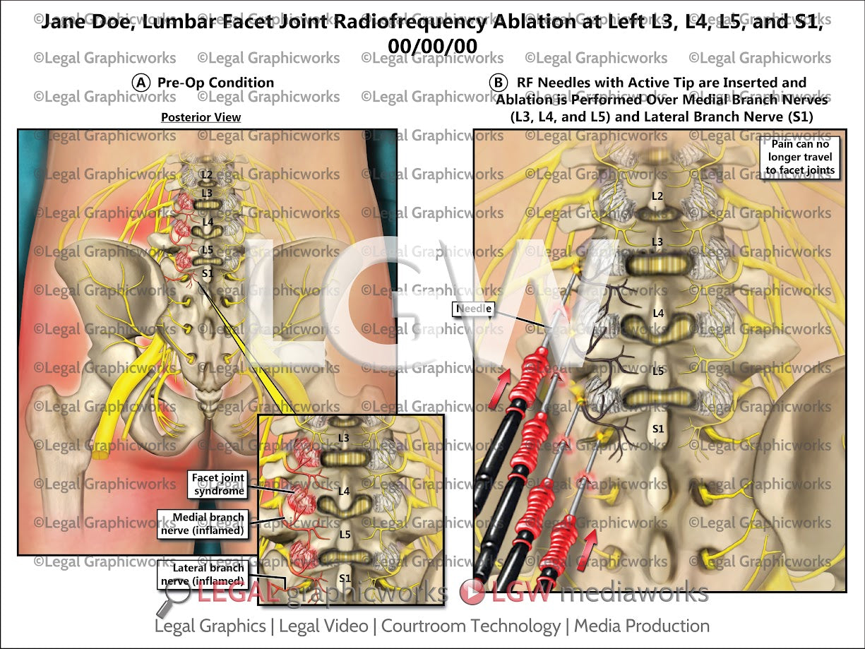 Lumbar Facet Joint Radiofrequency Ablation at Left L3, L4, L5, and S1
