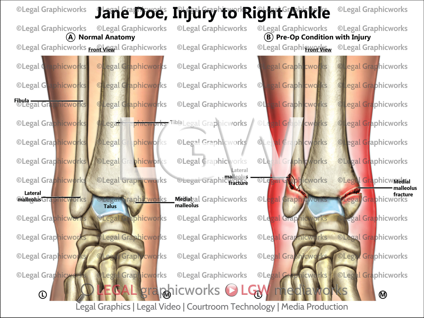 Injury to Right Ankle