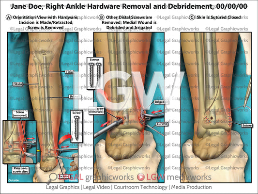 Right Ankle Hardware Removal and Debridement