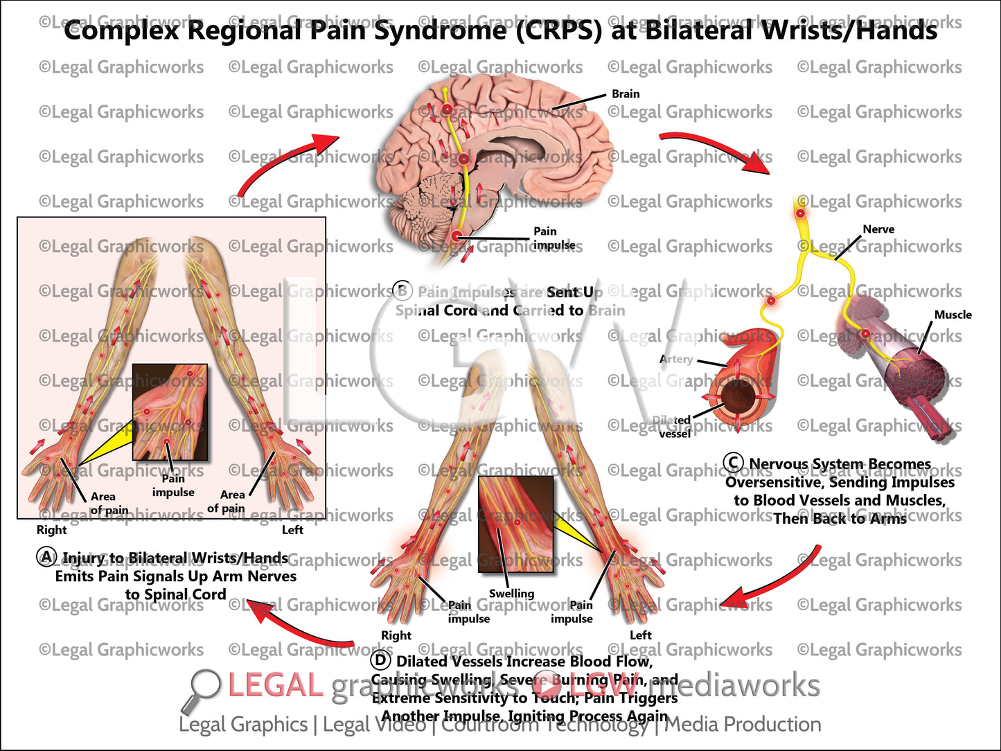 Complex Regional Pain Syndrome (CRPS) at Bilateral Wrists/Hands