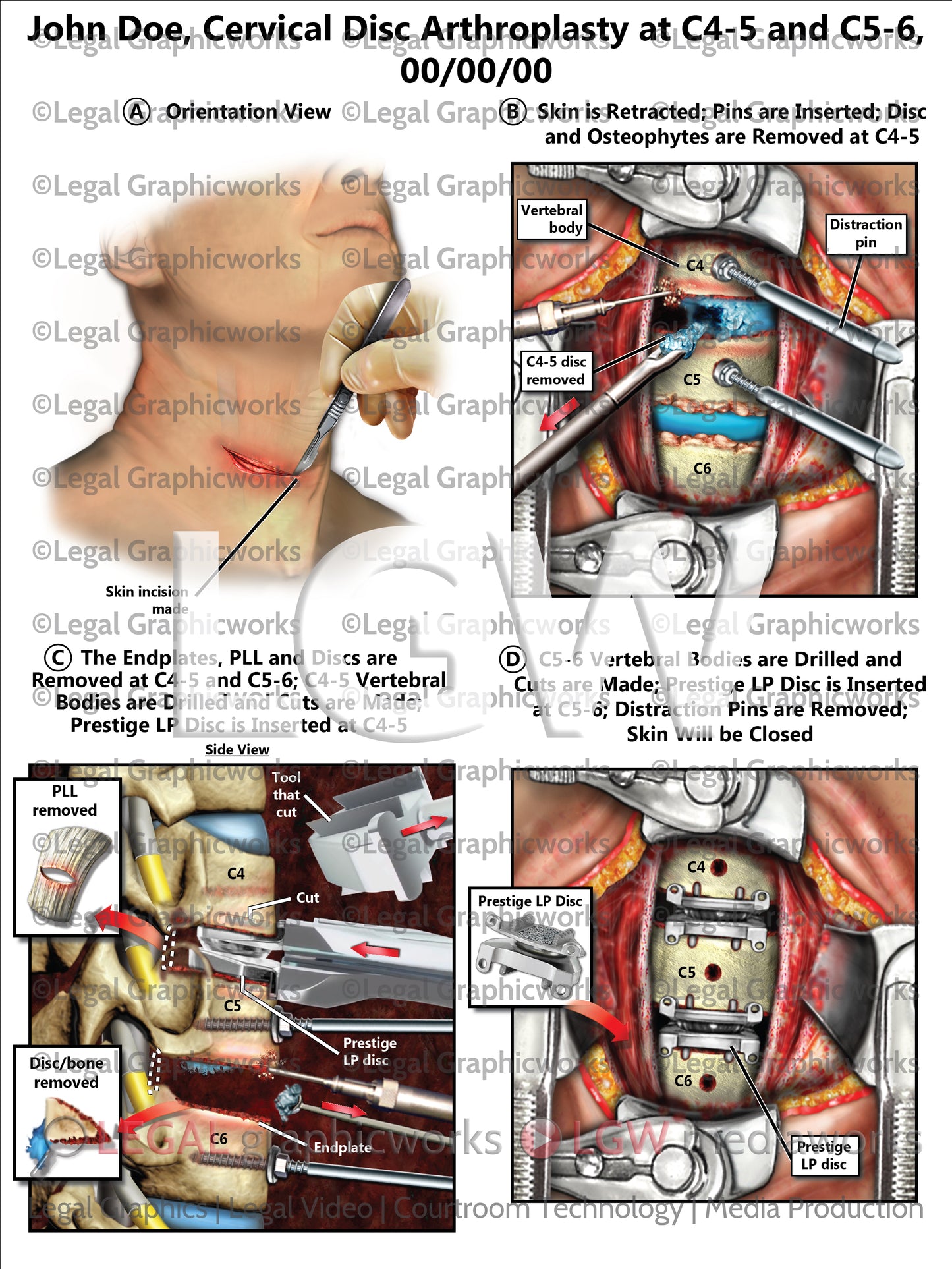 Cervical Disc Arthroplasty at C4-5 and C5-6