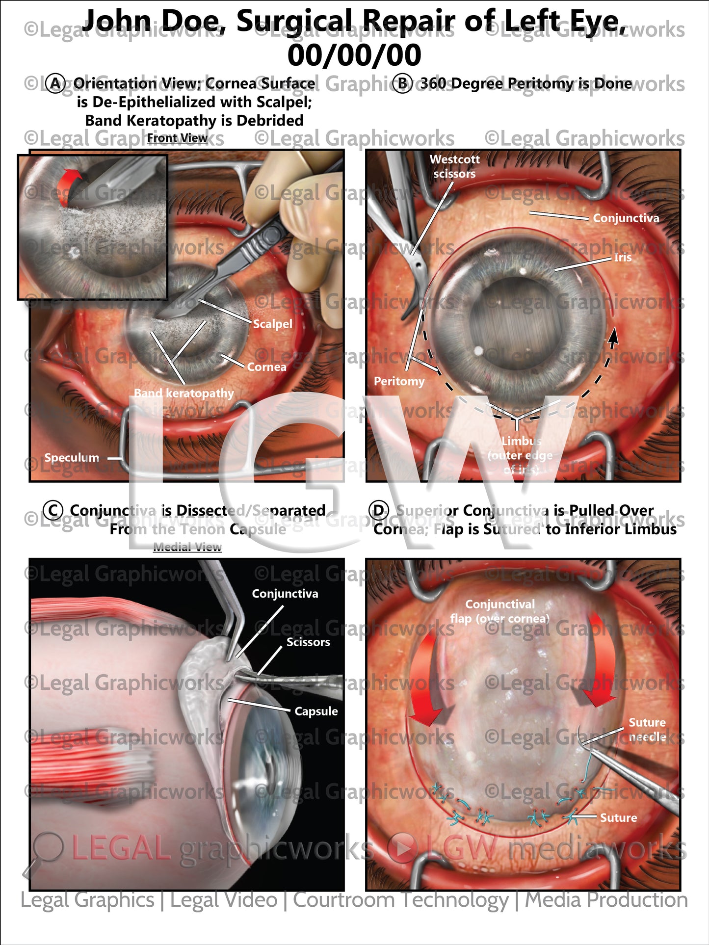 Surgical Repair of Left Eye