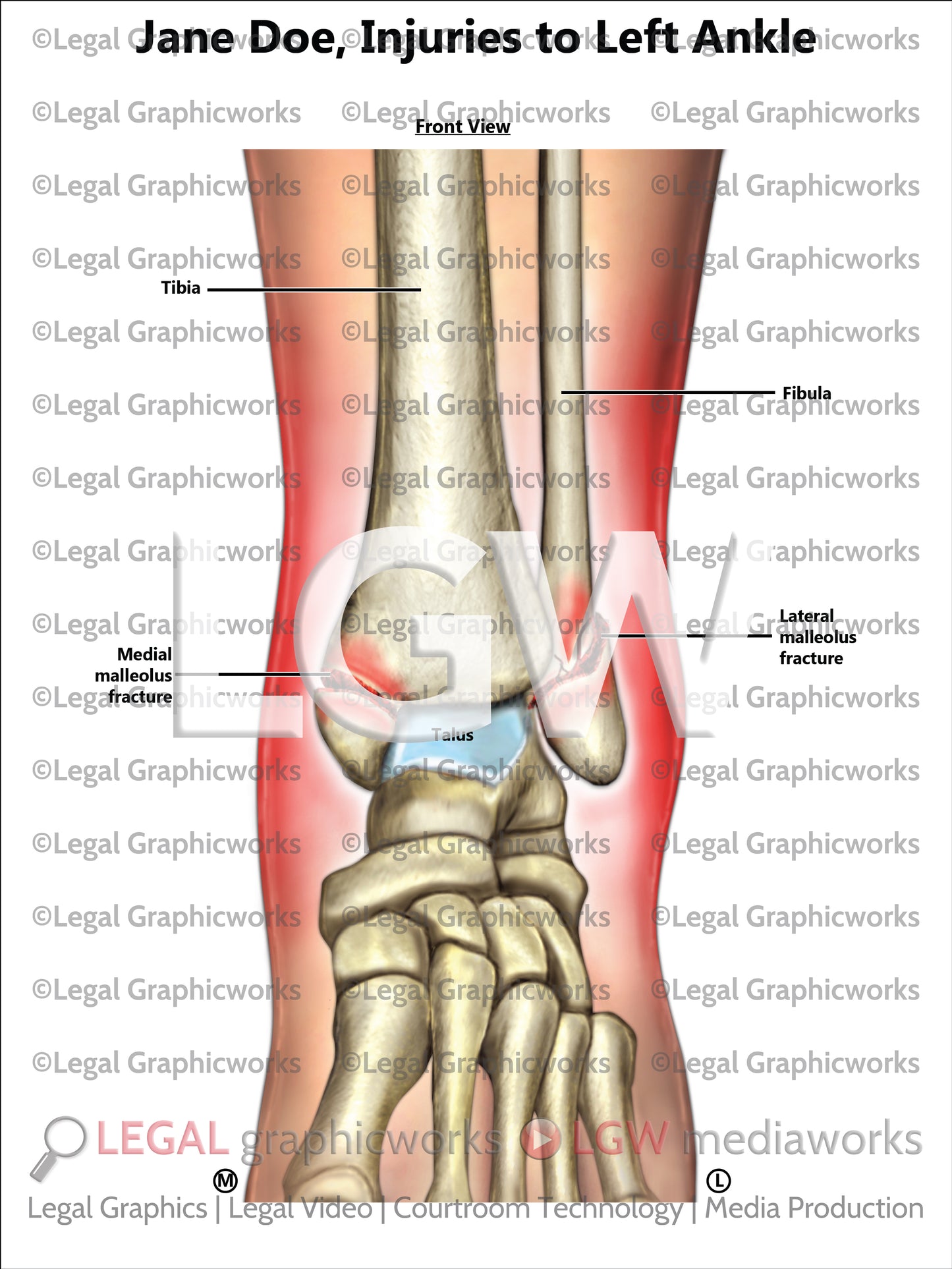 Injuries to Left Ankle