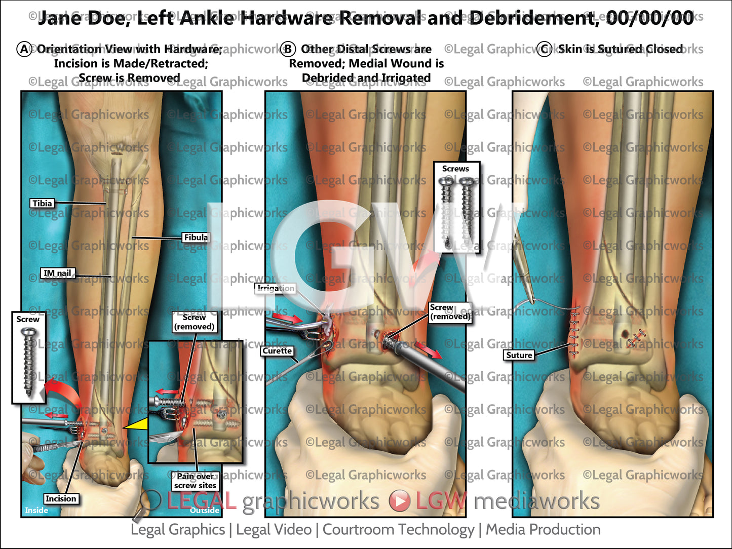 Left Ankle Hardware Removal and Debridement