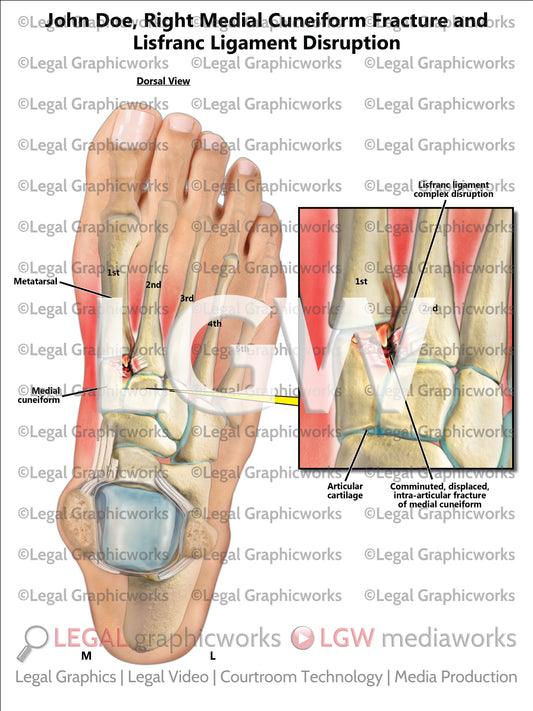 Right Medial Cuneiform Fracture and Lisfranc Ligament Disruption