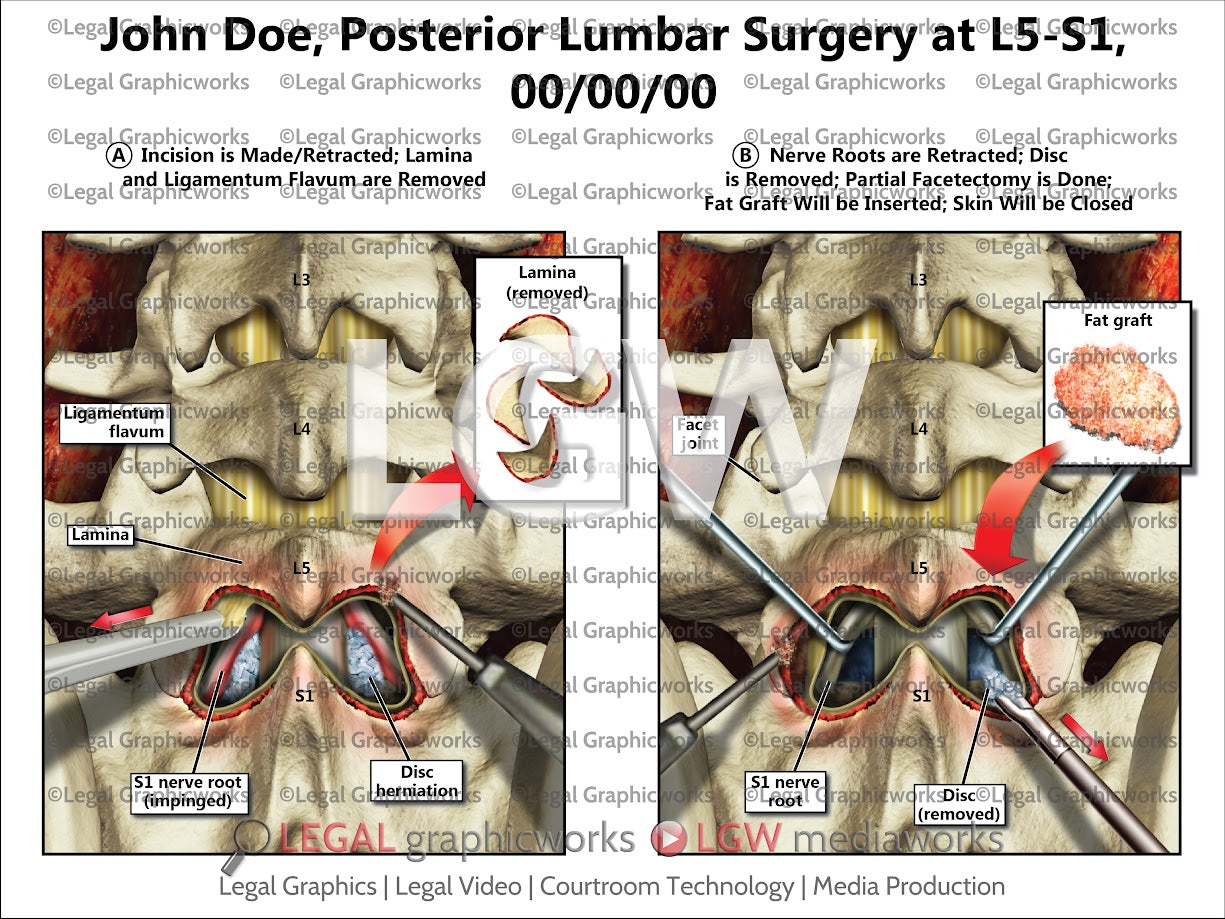 Posterior Lumbar Surgery at L5-S1
