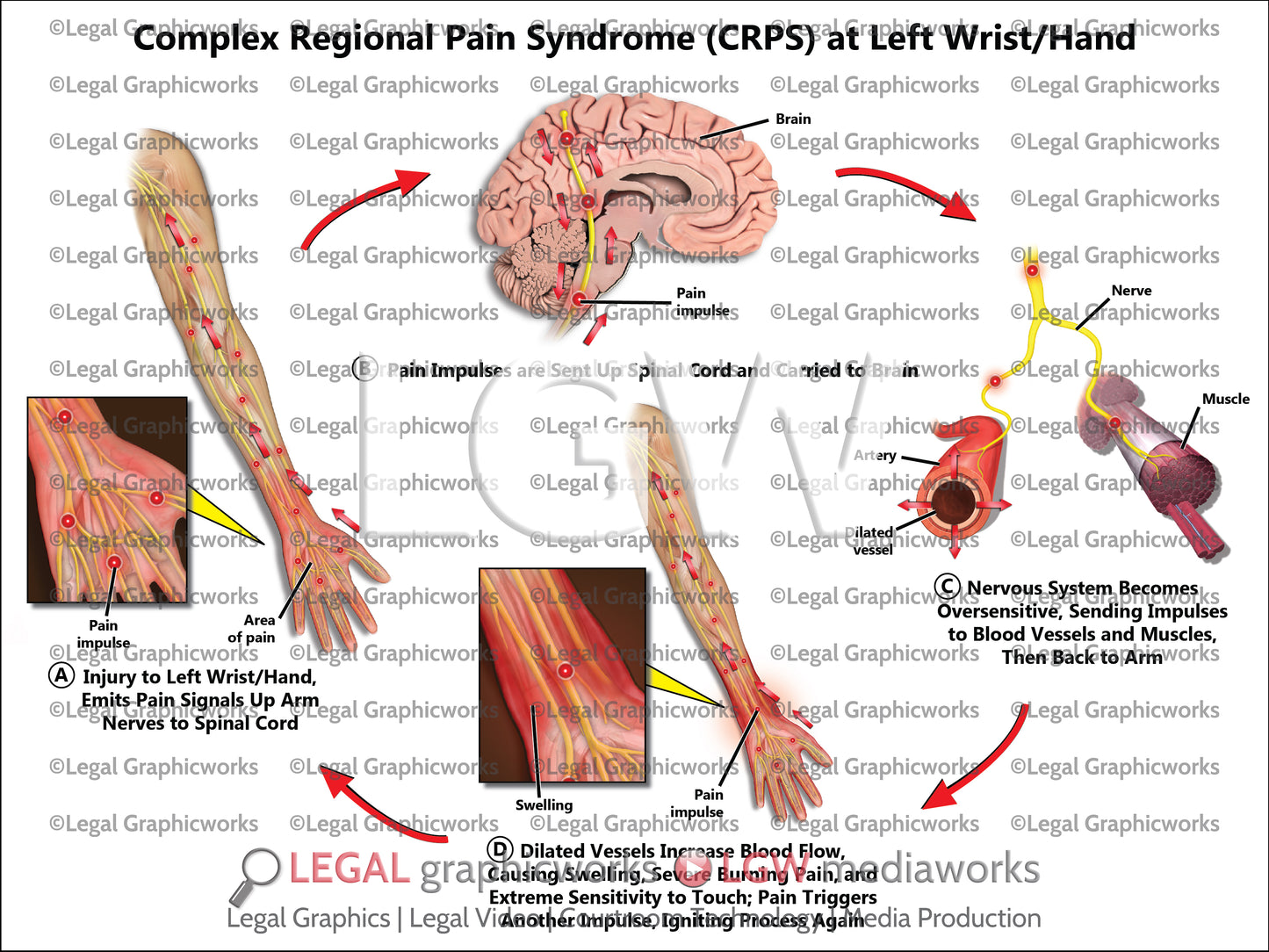 Complex Regional Pain Syndrome (CRPS) at Left Wrist/Hand