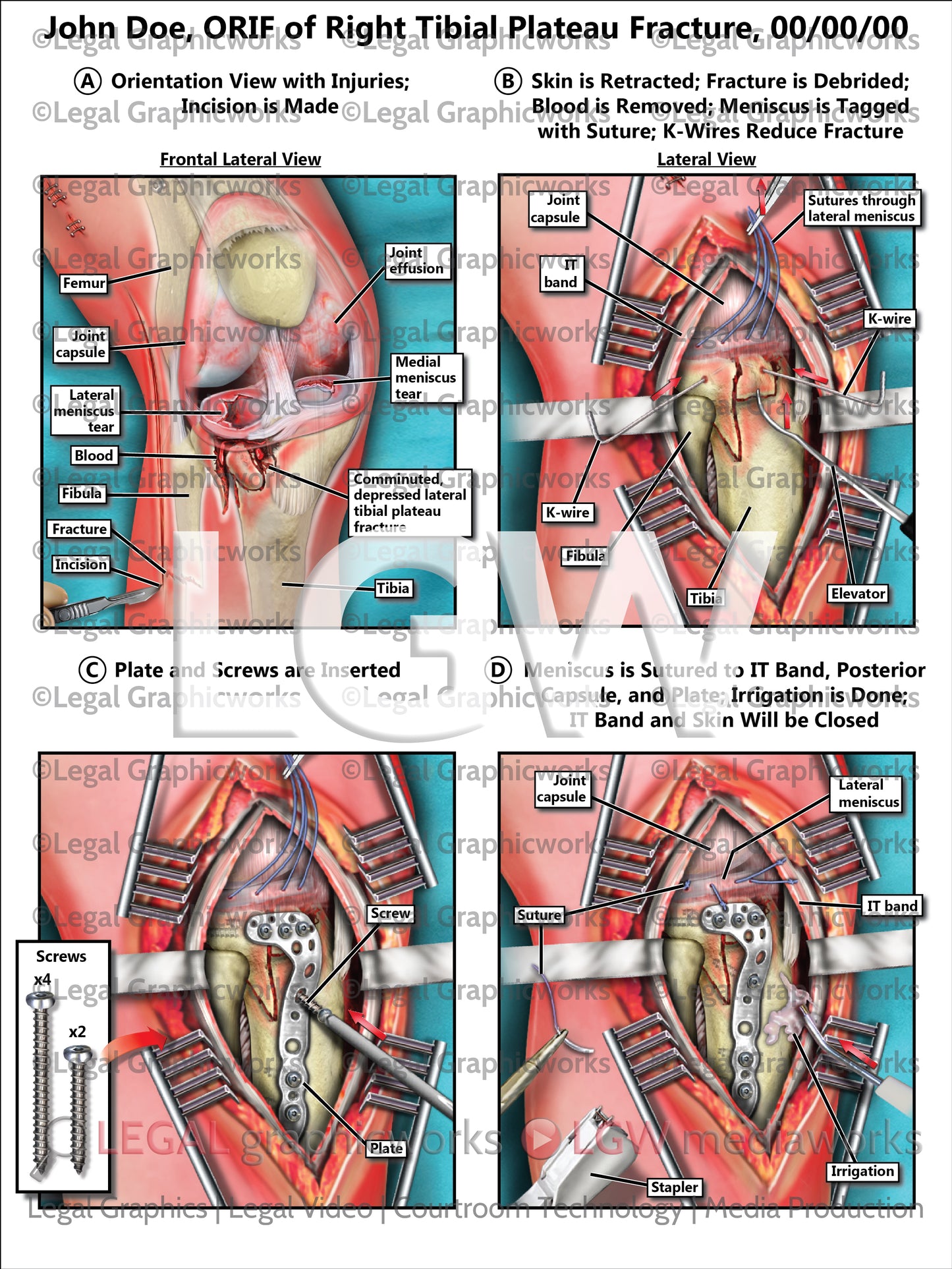 ORIF of Right Tibial Plateau Fracture