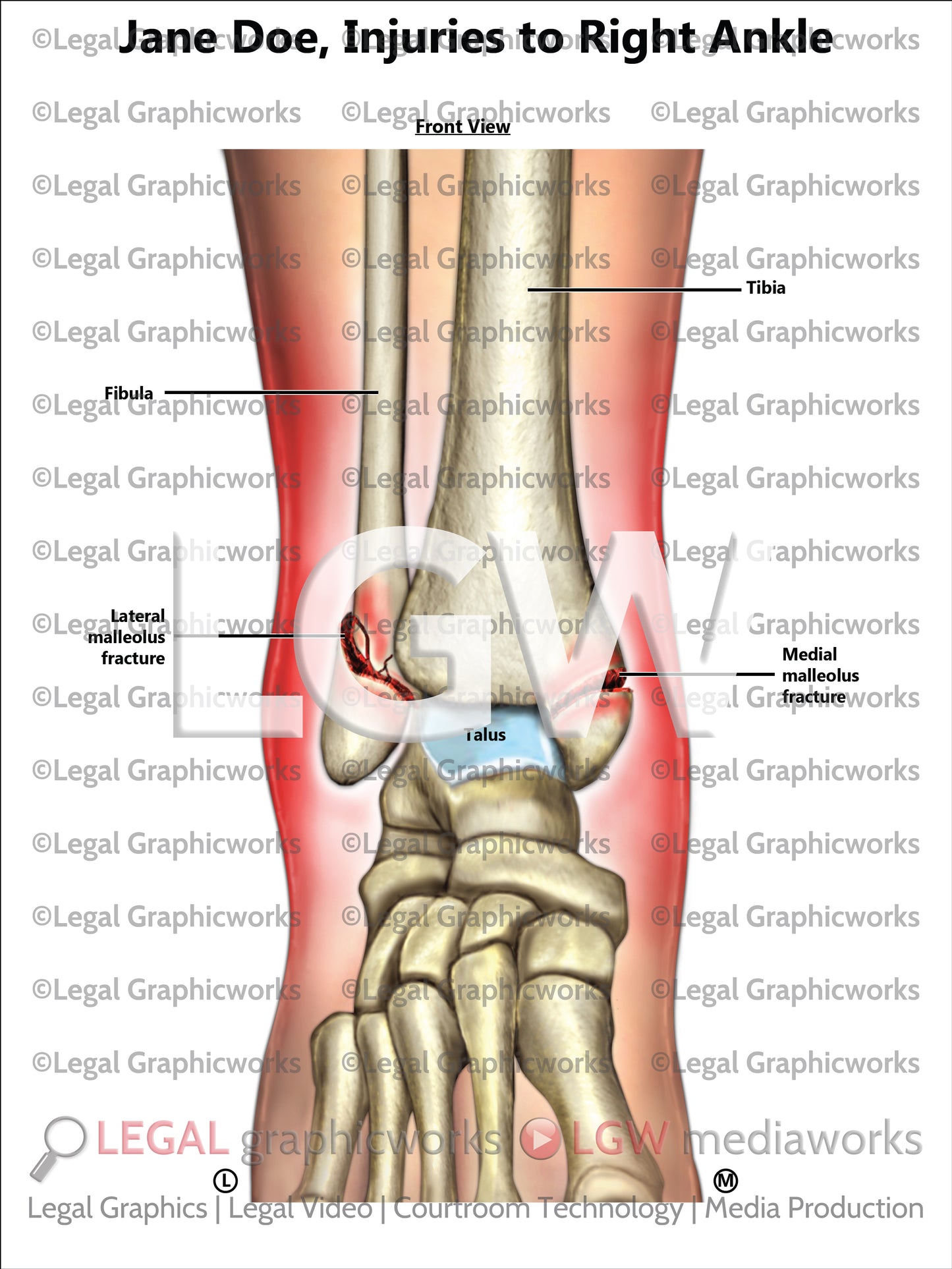 Injuries to Right Ankle