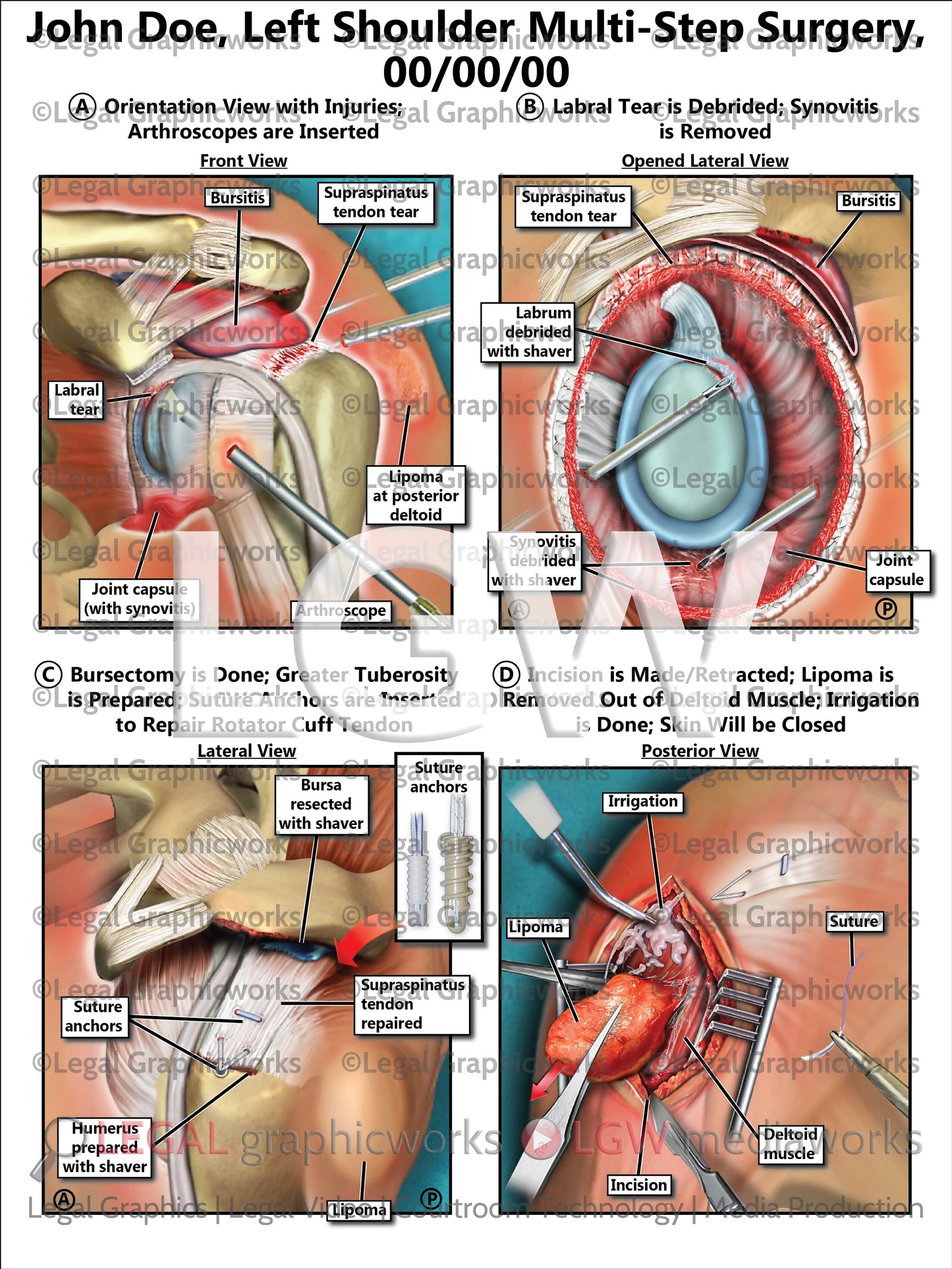 Left Shoulder Multi-Step Surgery