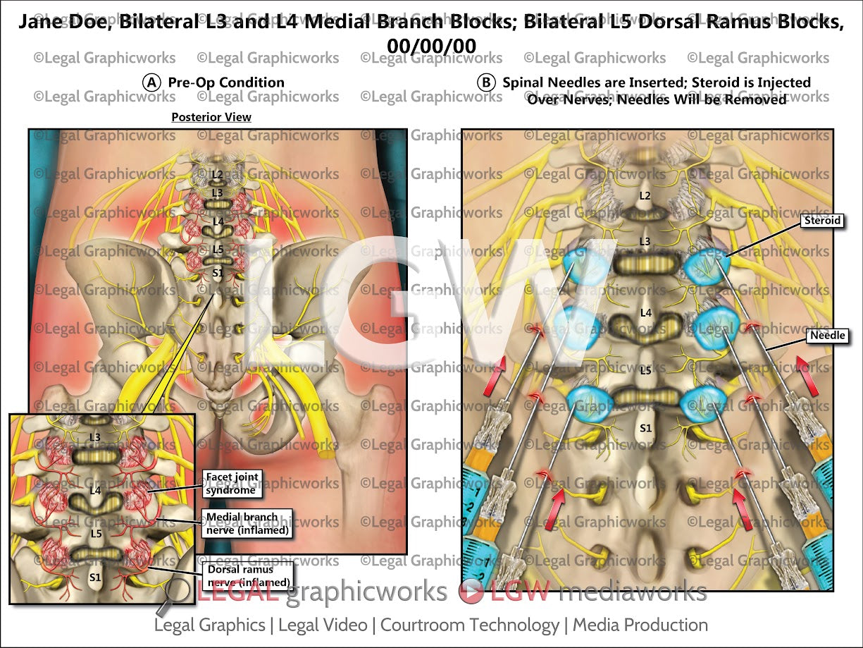 Bilateral L3 and L4 Medial Branch Blocks; Bilateral L5 Dorsal Ramus Blocks