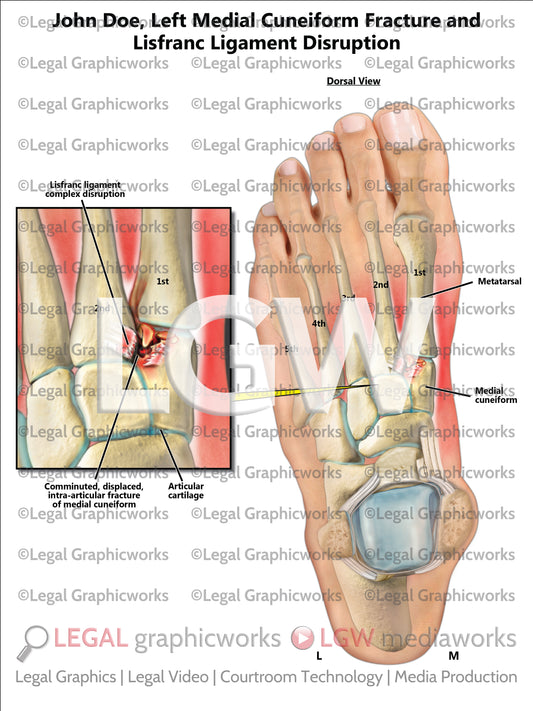 Left Medial Cuneiform Fracture and Lisfranc Ligament Disruption