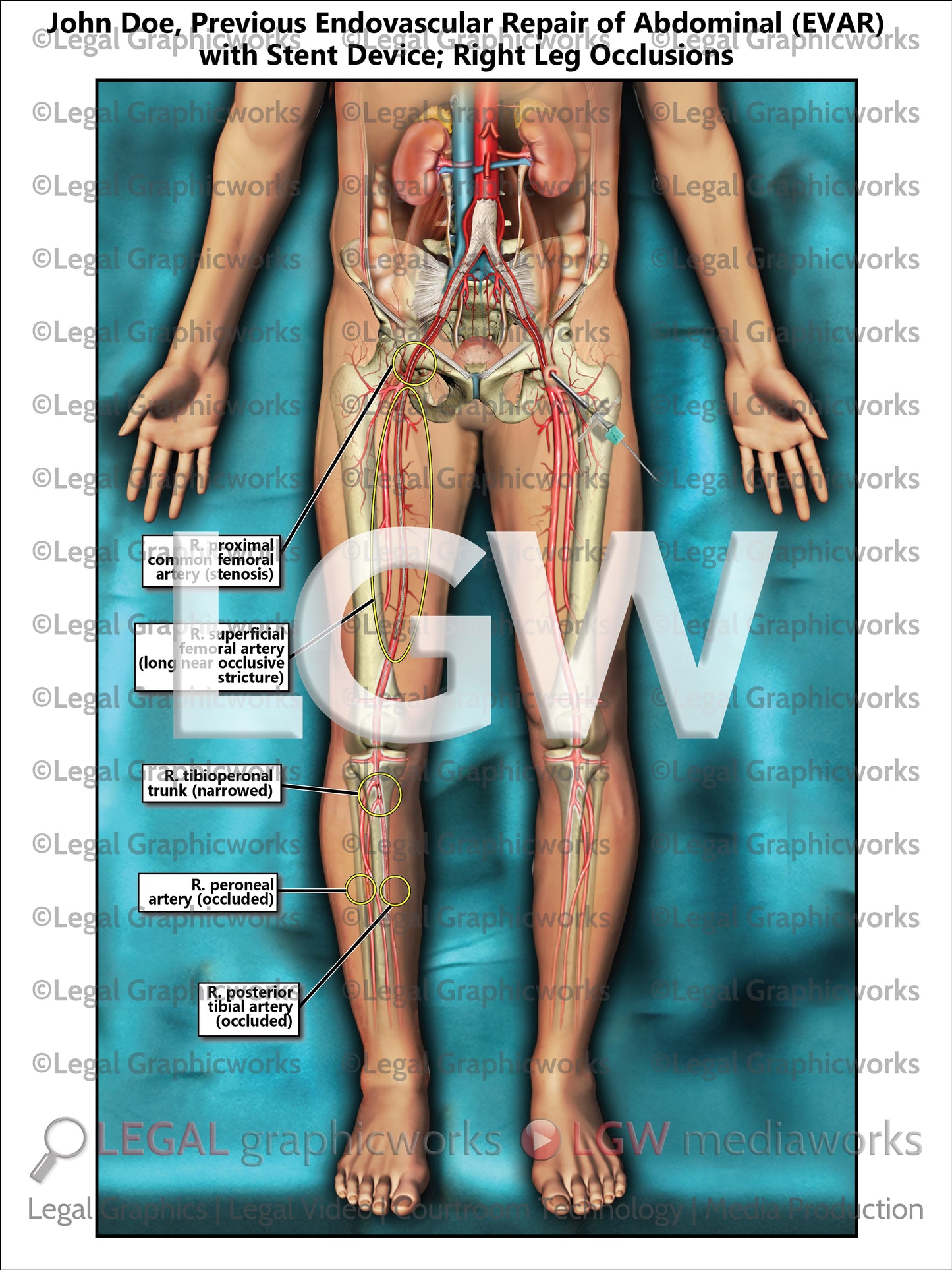 Previous Endovascular Repair of Abdominal (EVAR) with Stent Device; Right Leg Occlusions