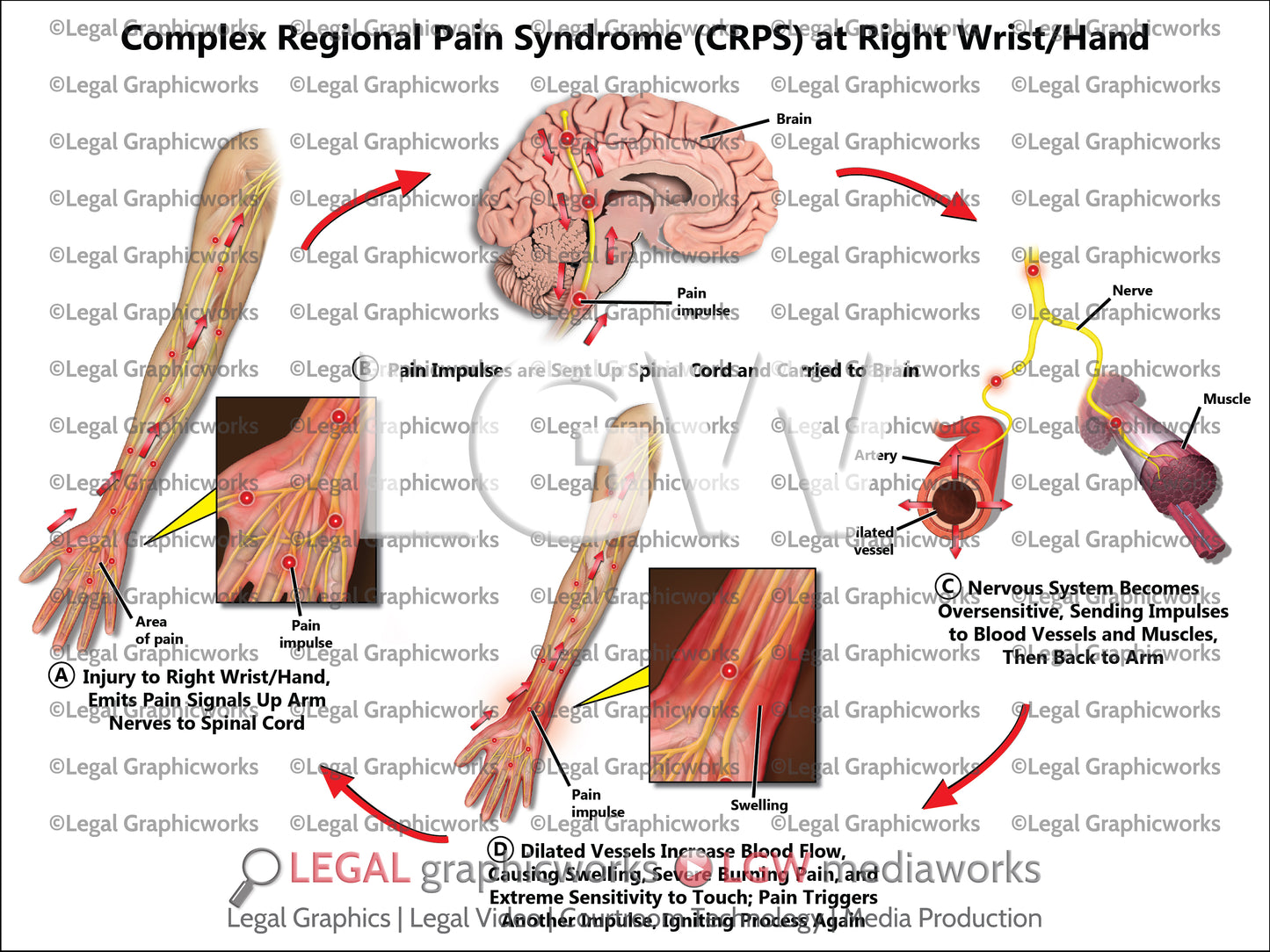 Complex Regional Pain Syndrome (CRPS) at Right Wrist/Hand
