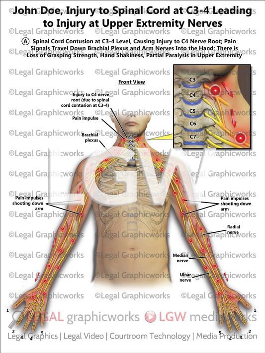 Injury to Spinal Cord at C3-4 Leading to Injury at Upper Extremity Nerves