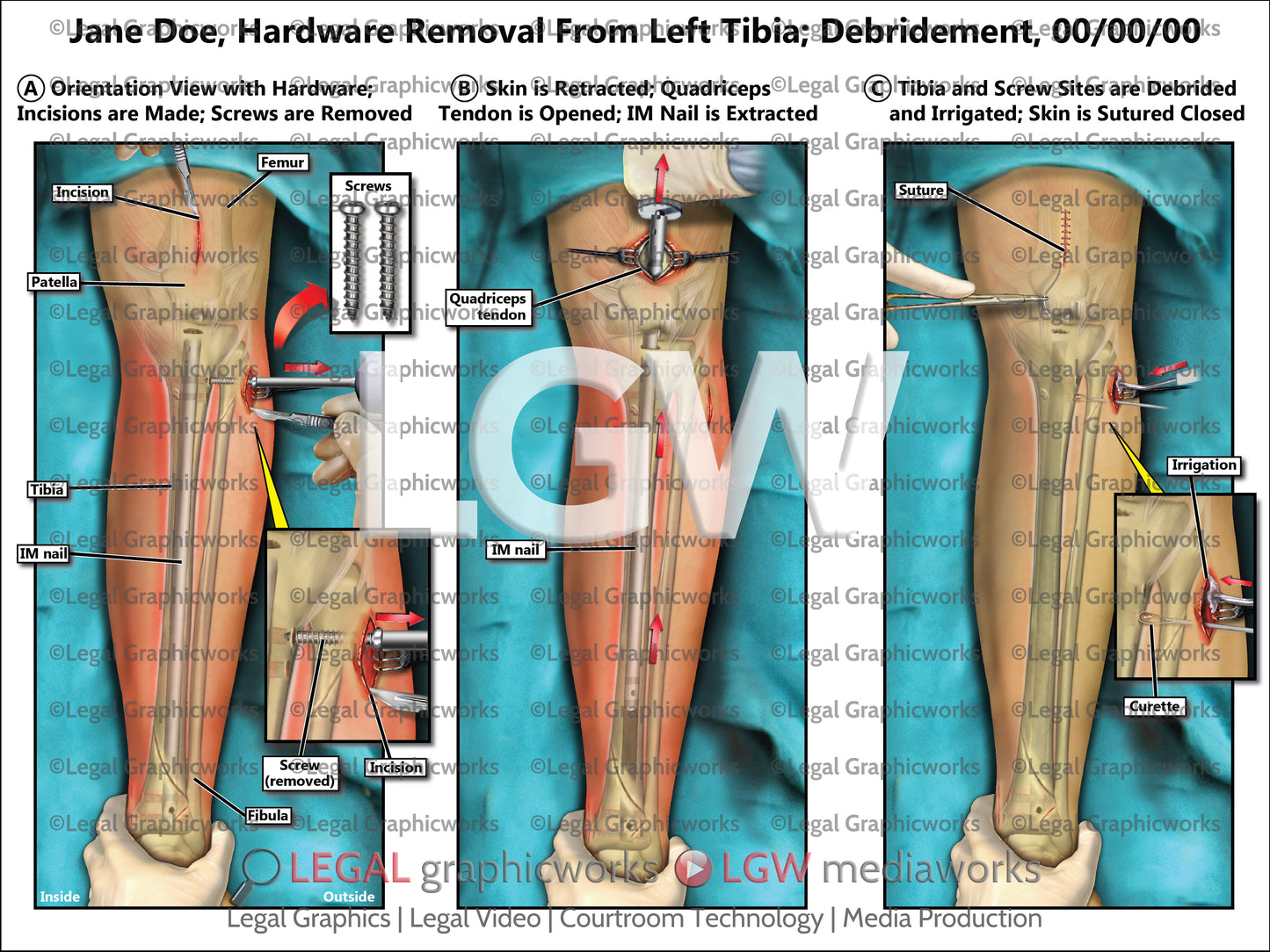Hardware Removal From Left Tibia; Debridement