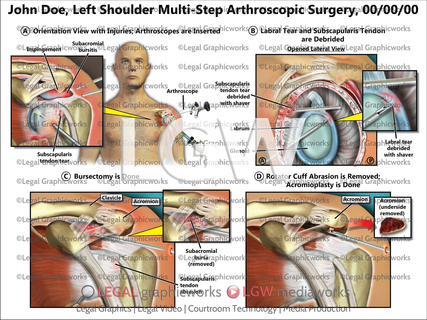 Left Shoulder Multi-Step Arthroscopic Surgery