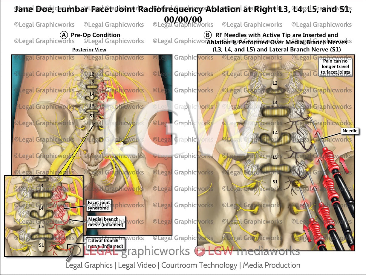Lumbar Facet Joint Radiofrequency Ablation at Right L3, L4, L5, and S1