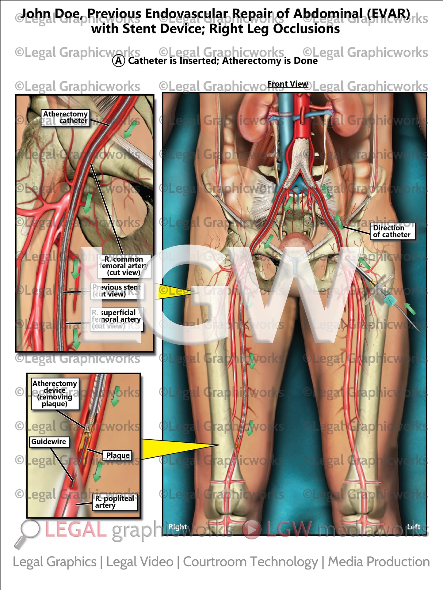 Previous Endovascular Repair of Abdominal (EVAR) with Stent Device; Right Leg Occlusions