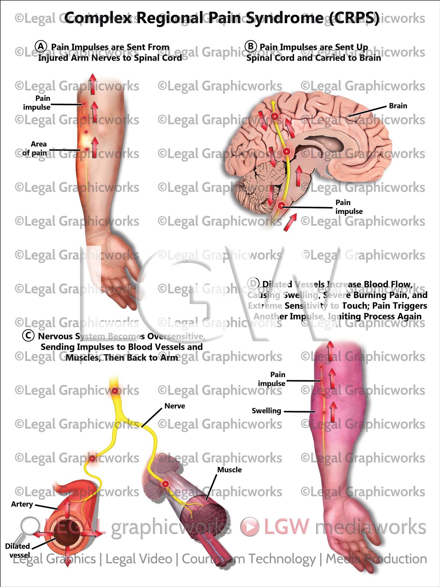 Complex Regional Pain Syndrome (CRPS)