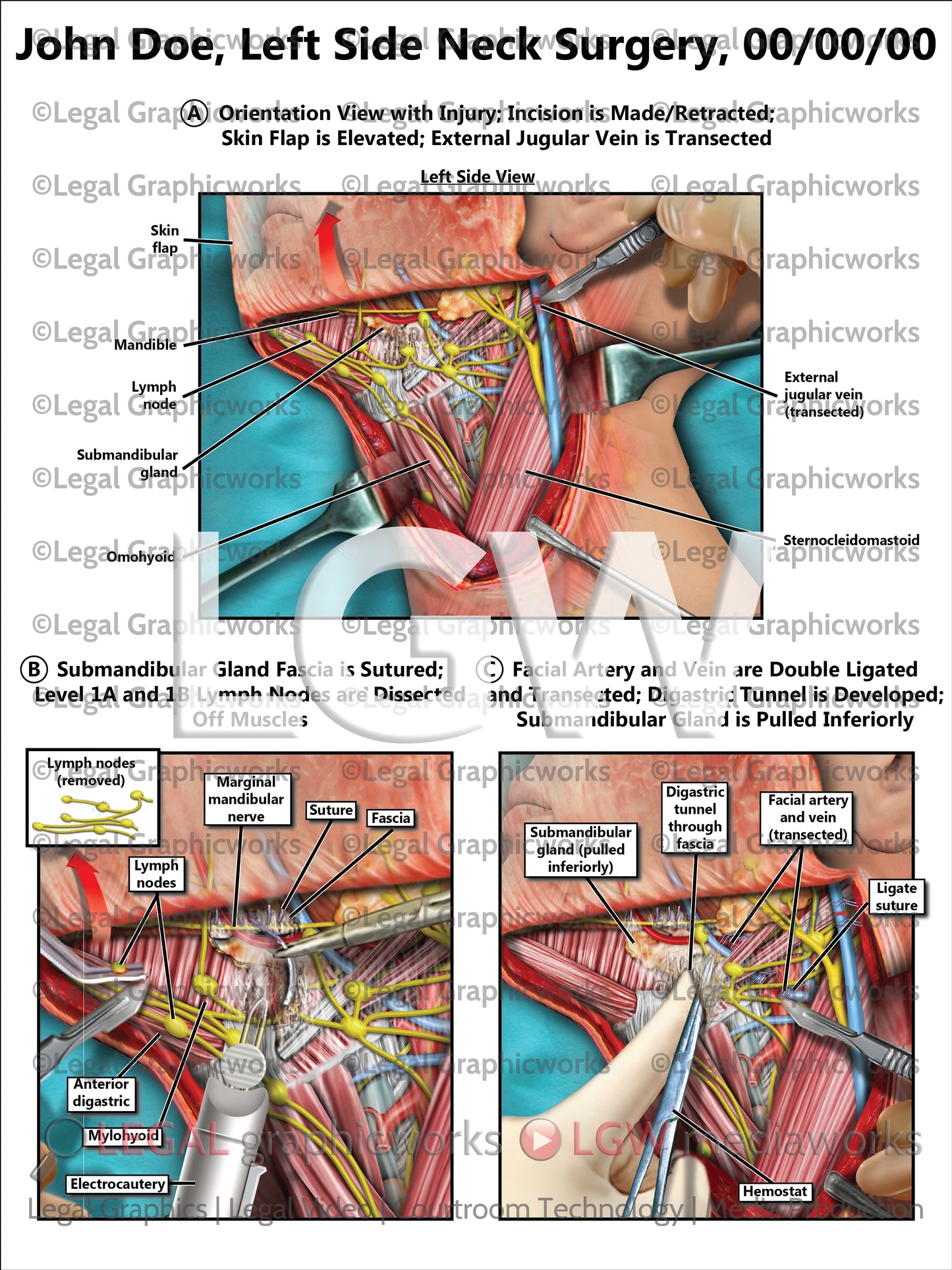 Left Side Neck Surgery