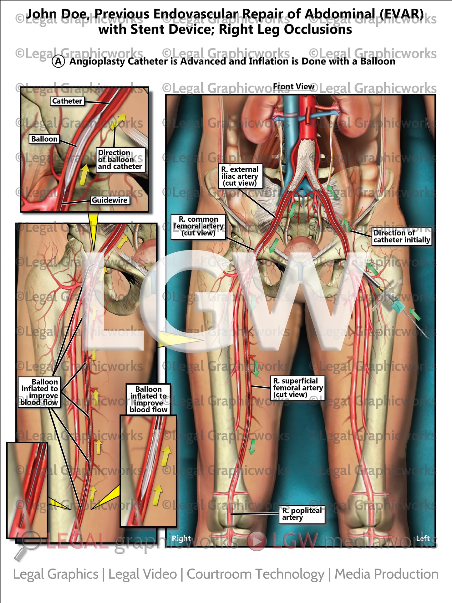 Previous Endovascular Repair of Abdominal (EVAR) with Stent Device; Right Leg Occlusions