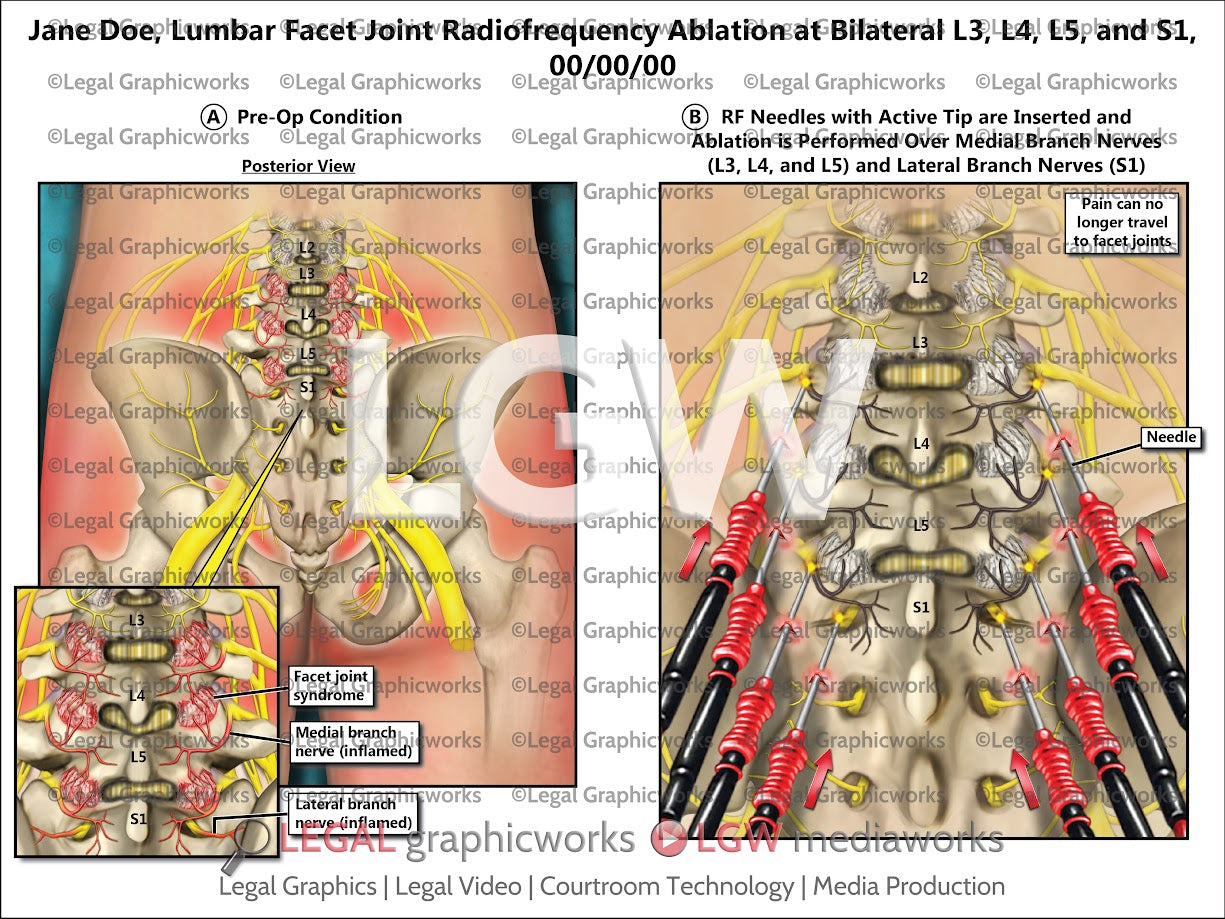 Lumbar Facet Joint Radiofrequency Ablation at Bilateral L3, L4, L5, and S1
