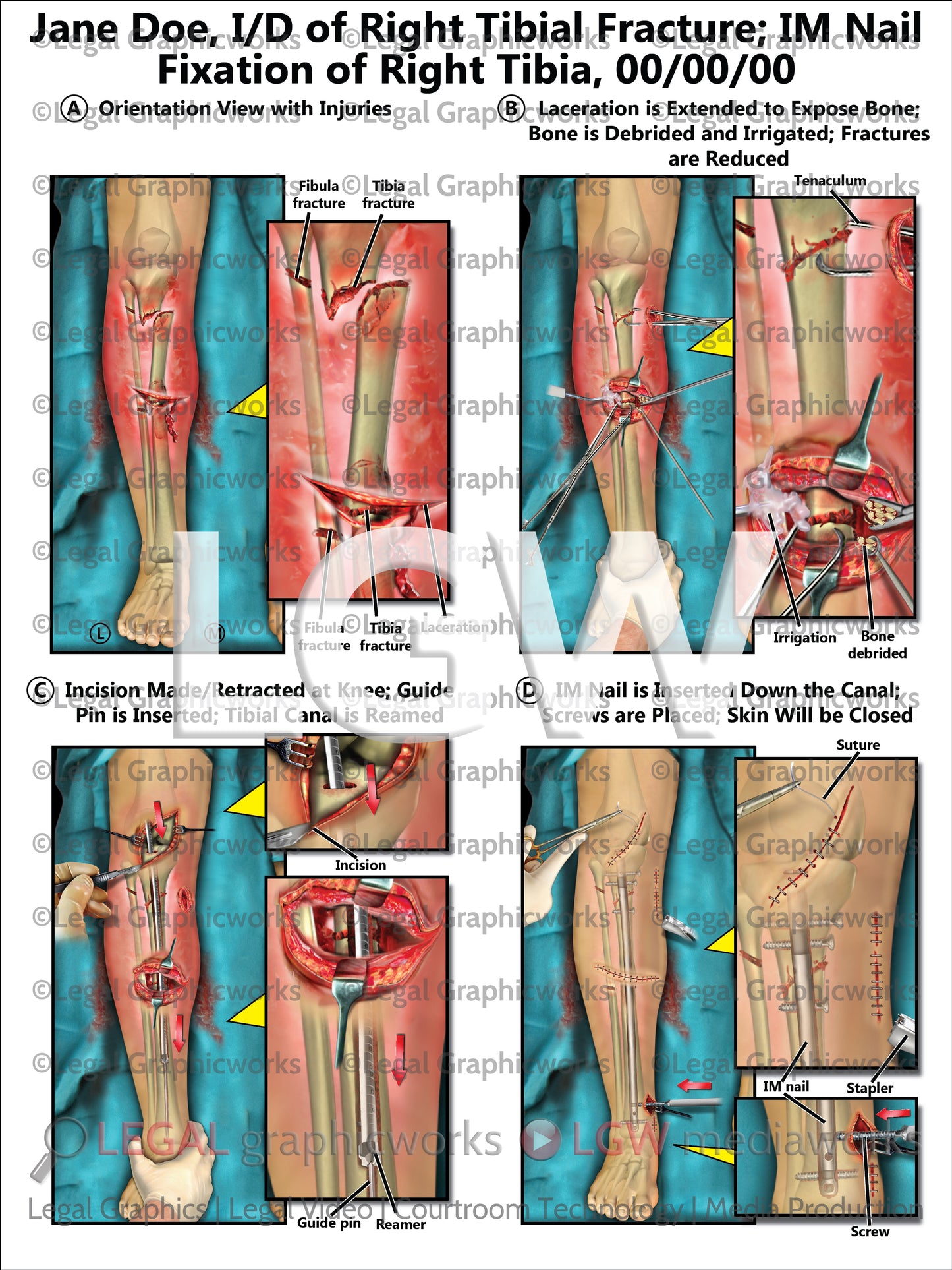 I/D of Right Tibial Fracture; IM Nail Fixation of Right Tibia
