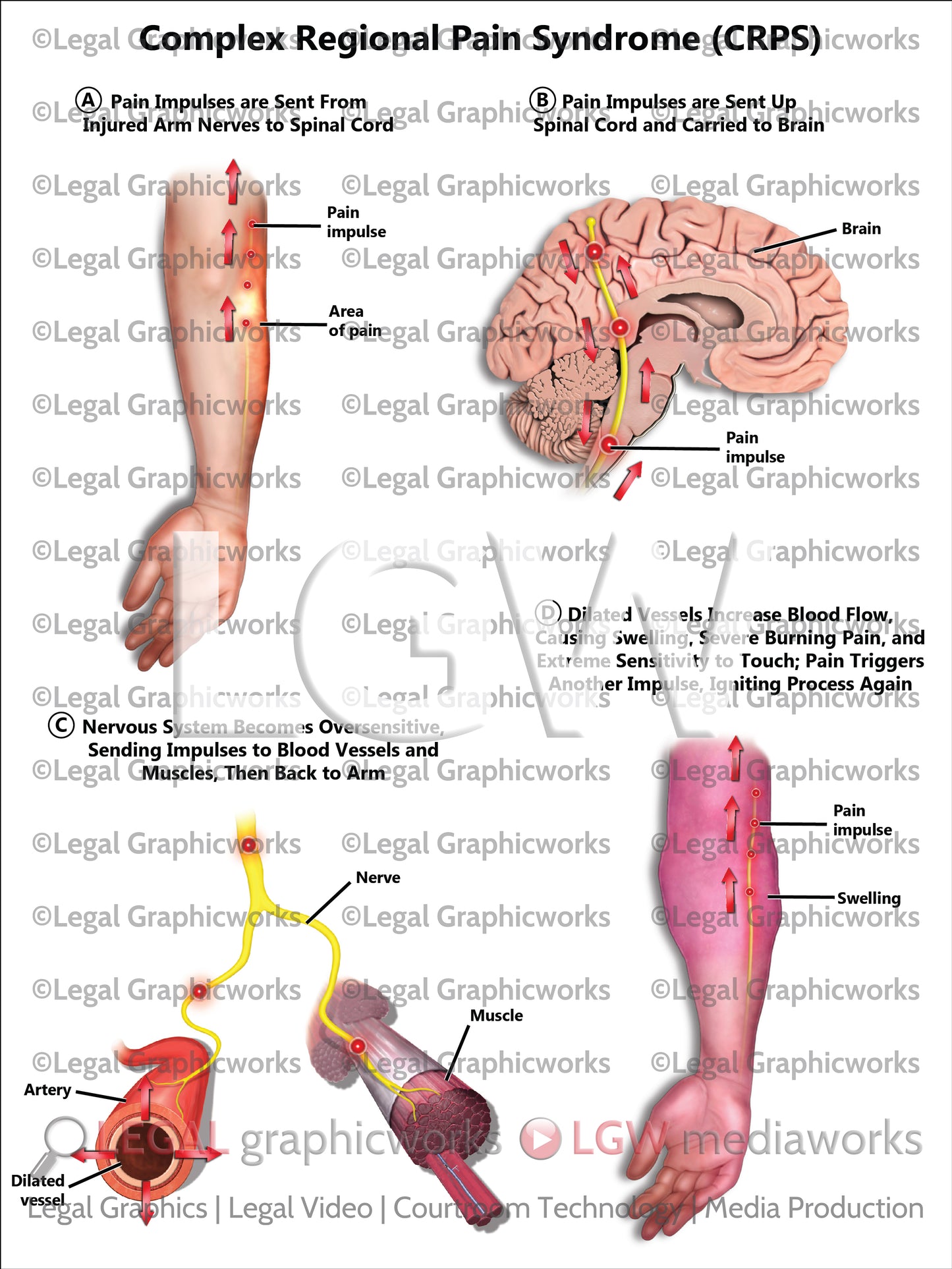 Complex Regional Pain Syndrome (CRPS)