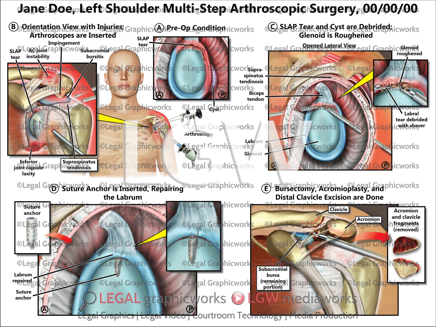 Left Shoulder Multi-Step Arthroscopic Surgery