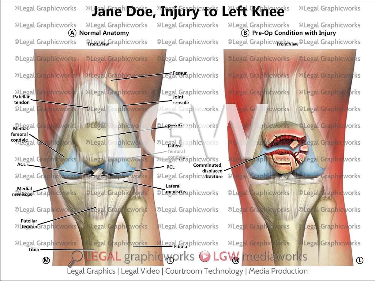 Injury to Left Knee