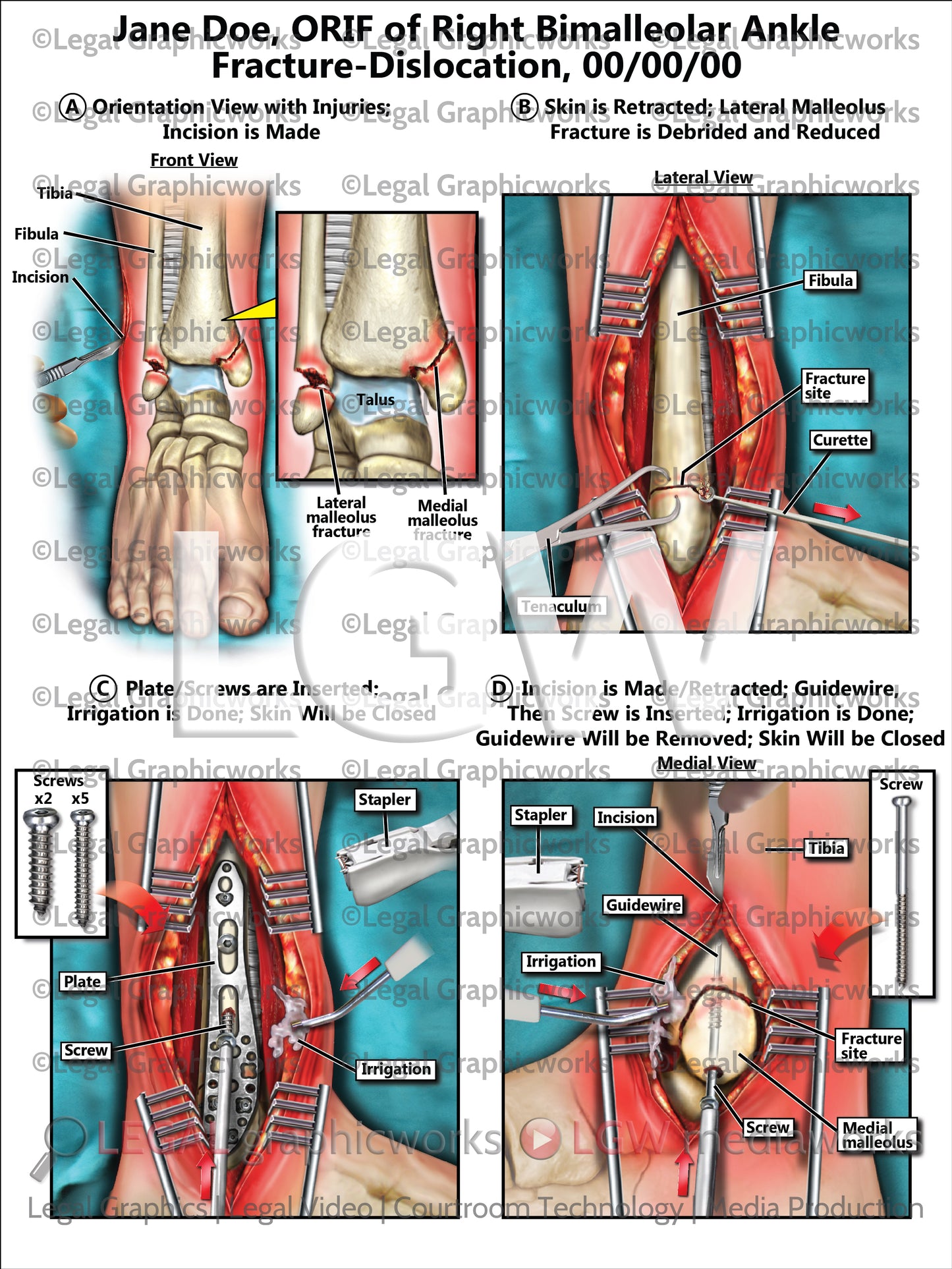 ORIF of Right Bimalleolar Ankle Fracture-Dislocation