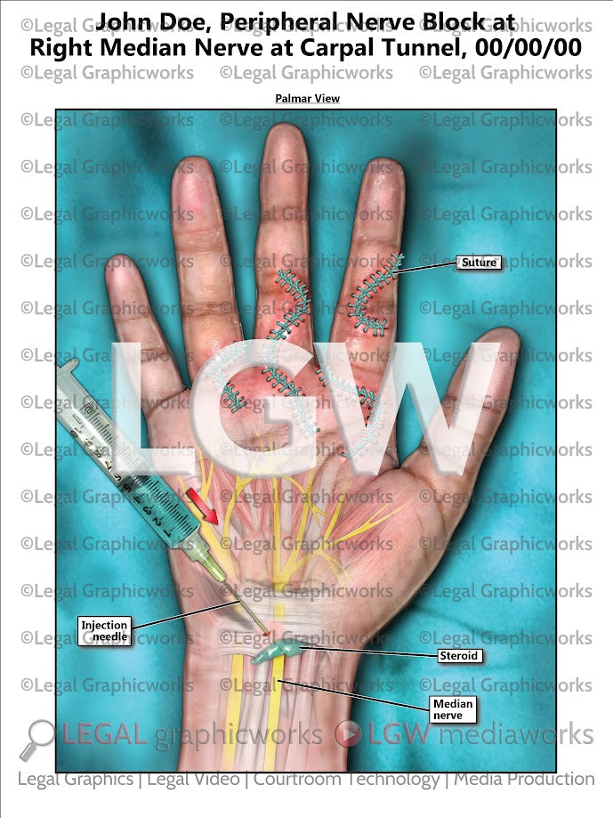 Peripheral Nerve Block at Right Median Nerve at Carpal Tunnel