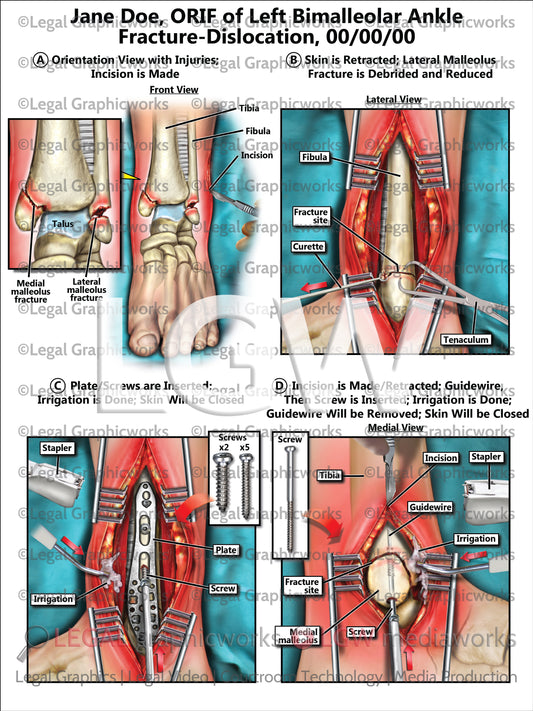 ORIF of Left Bimalleolar Ankle Fracture-Dislocation