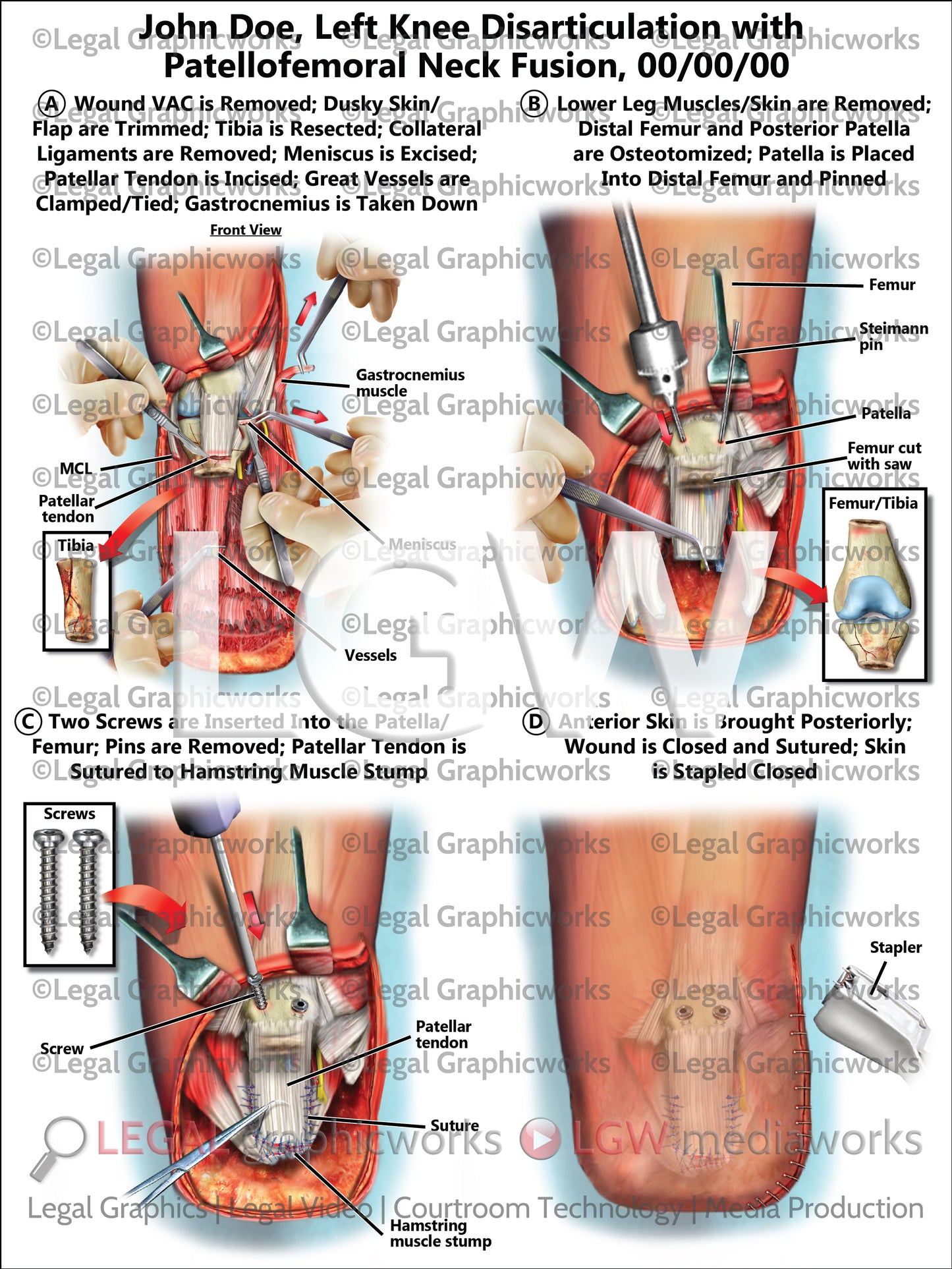 Left Knee Disarticulation with Patellofemoral Neck Fusion