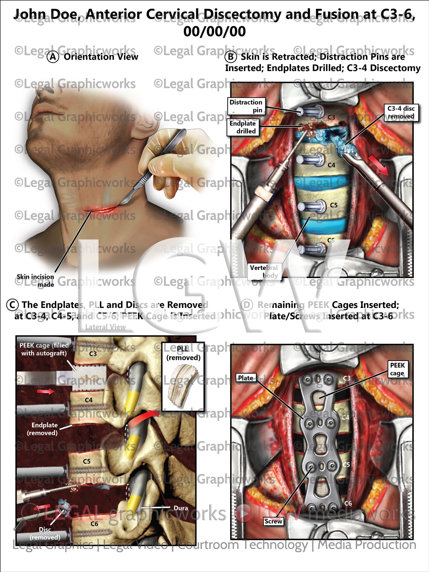 Anterior Cervical Discectomy and Fusion at C3-6