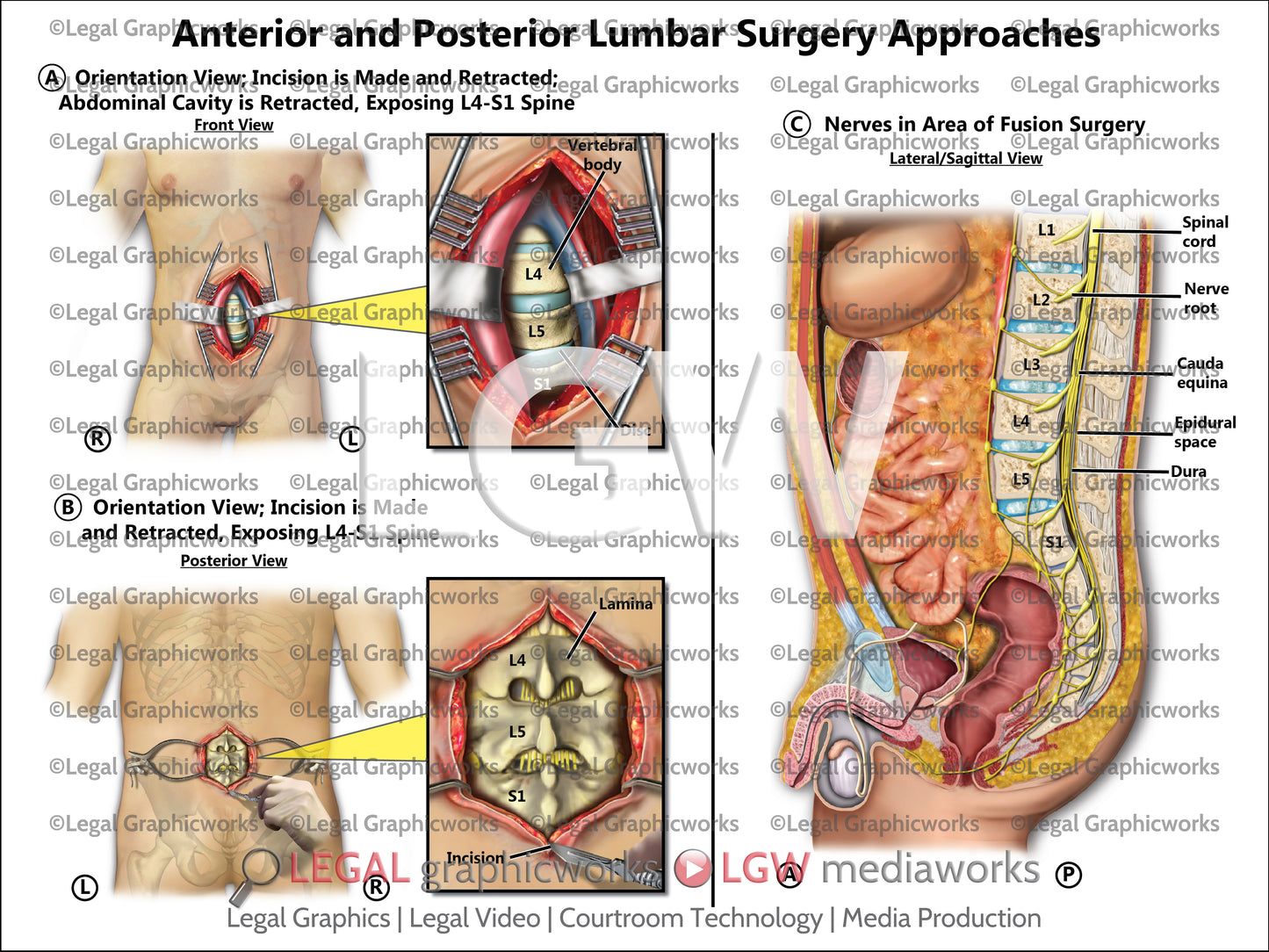 Anterior and Posterior Lumbar Surgery Approaches